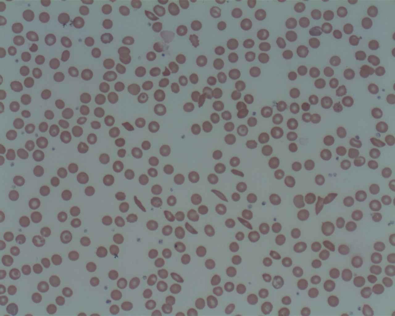 A stained blood smear showing the elongated, sickle-shaped red blood cells that define sickle cell anaemia.