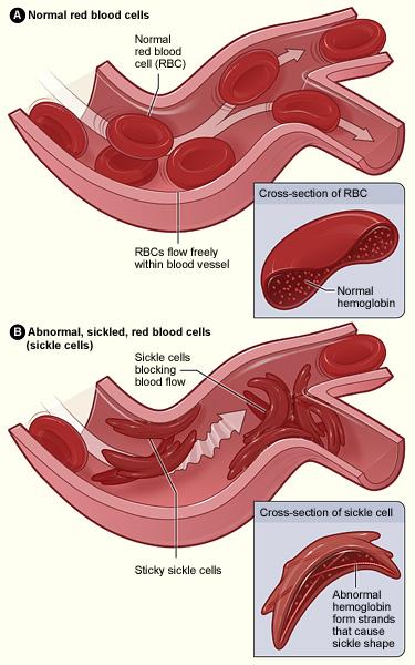 Medical illustration comparing normal round red blood cells with crescent-shaped sickled cells inside a blood vessel.